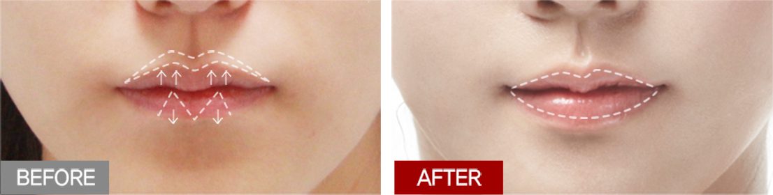 1 SARAYU CLINICS Lip Reduction Treatment in Delhi