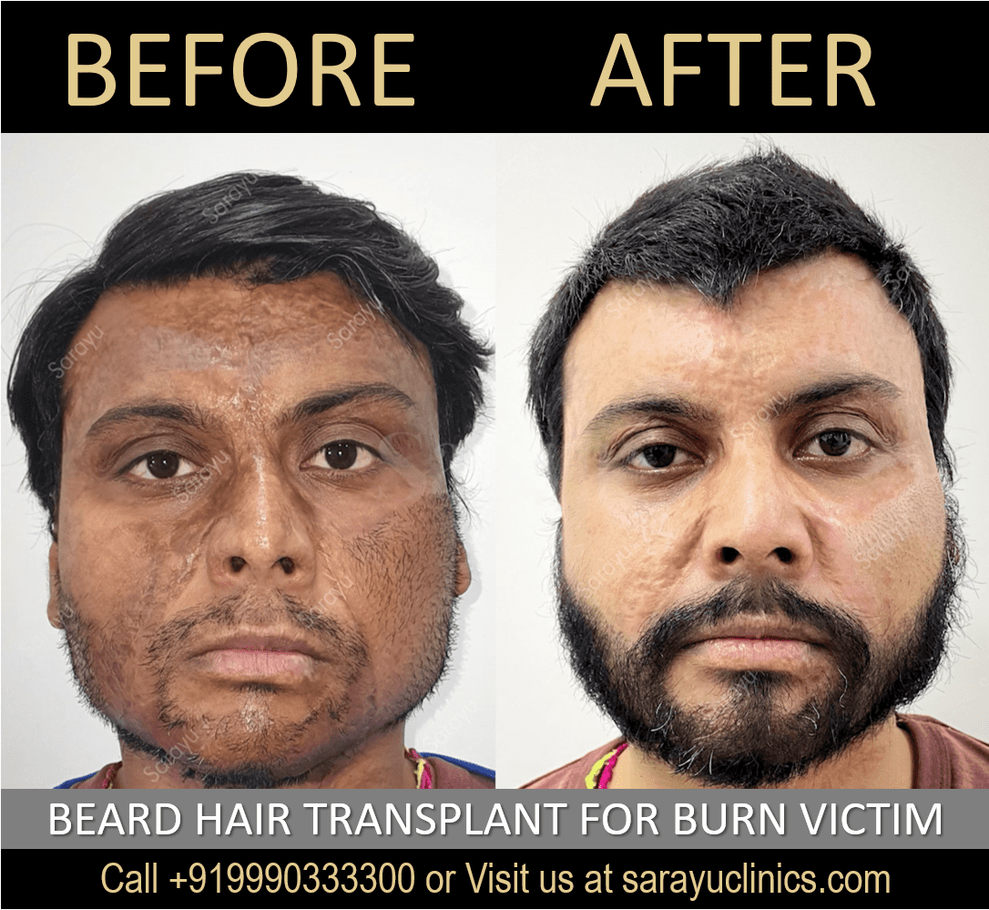 Beard Hair Transplant Results for a Burn Victim in Delhi SARAYU CLINICS Beard Hair Transplant in Delhi