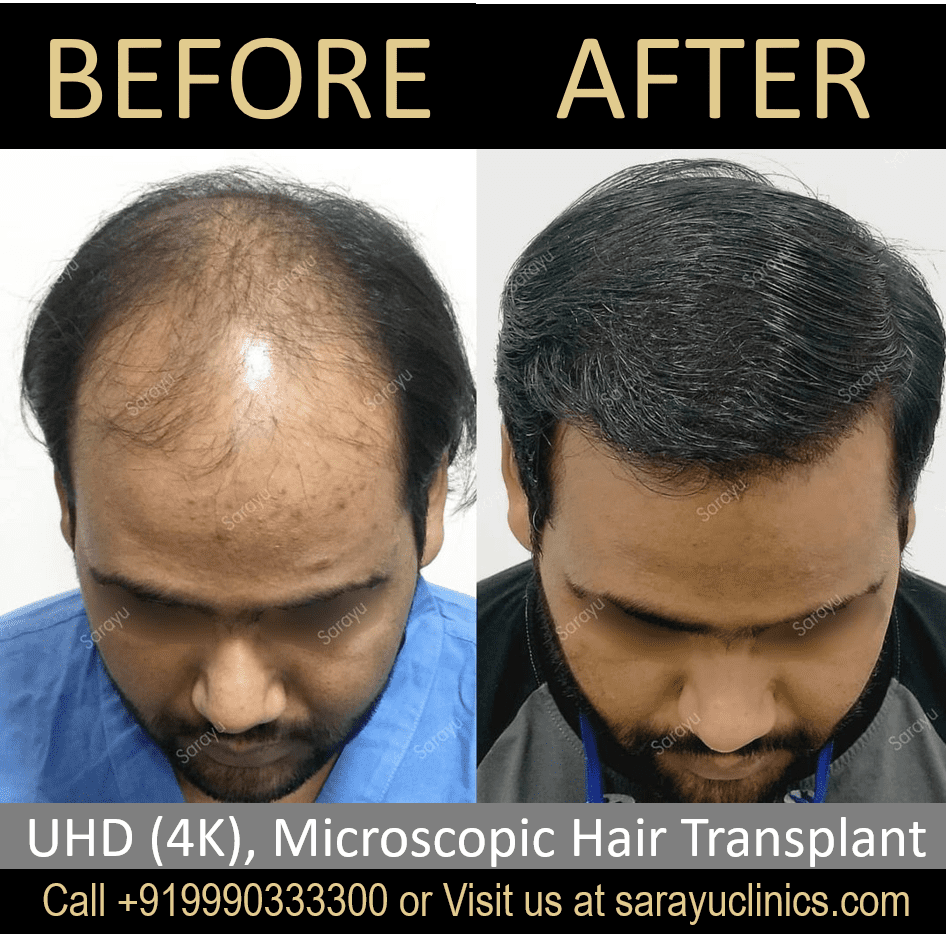 Best Clinic for Hair Transplant in Delhi SARAYU CLINICS PRP Treatment Delhi for hair loss in Delhi