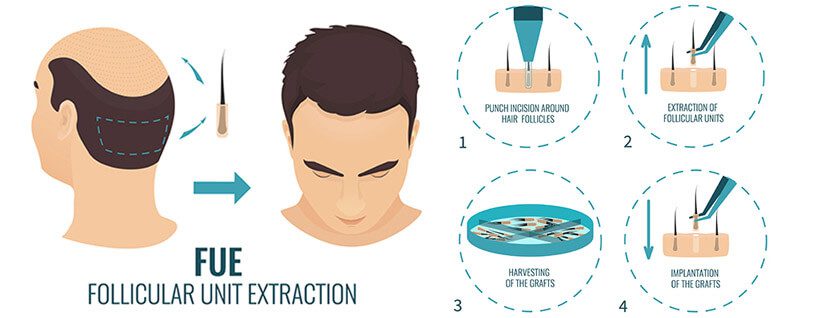 FUE Hair Transplant in Delhi India SARAYU CLINICS FUE Hair Transplant in Delhi