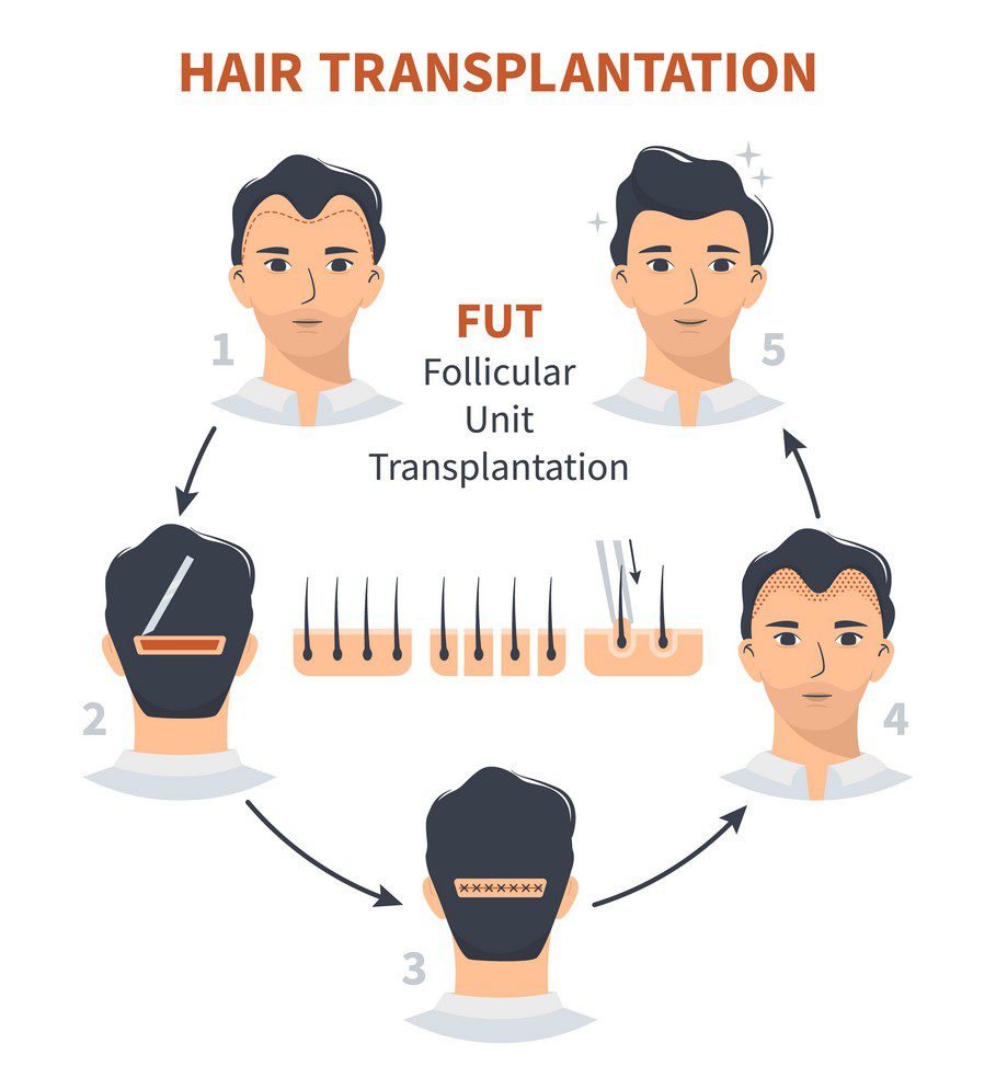 FUT HAIR TRANSPLANT IN DELHI AT SARAYU HAIR RESTORATION CLINIC SARAYU CLINICS FUT Hair Transplant in Delhi