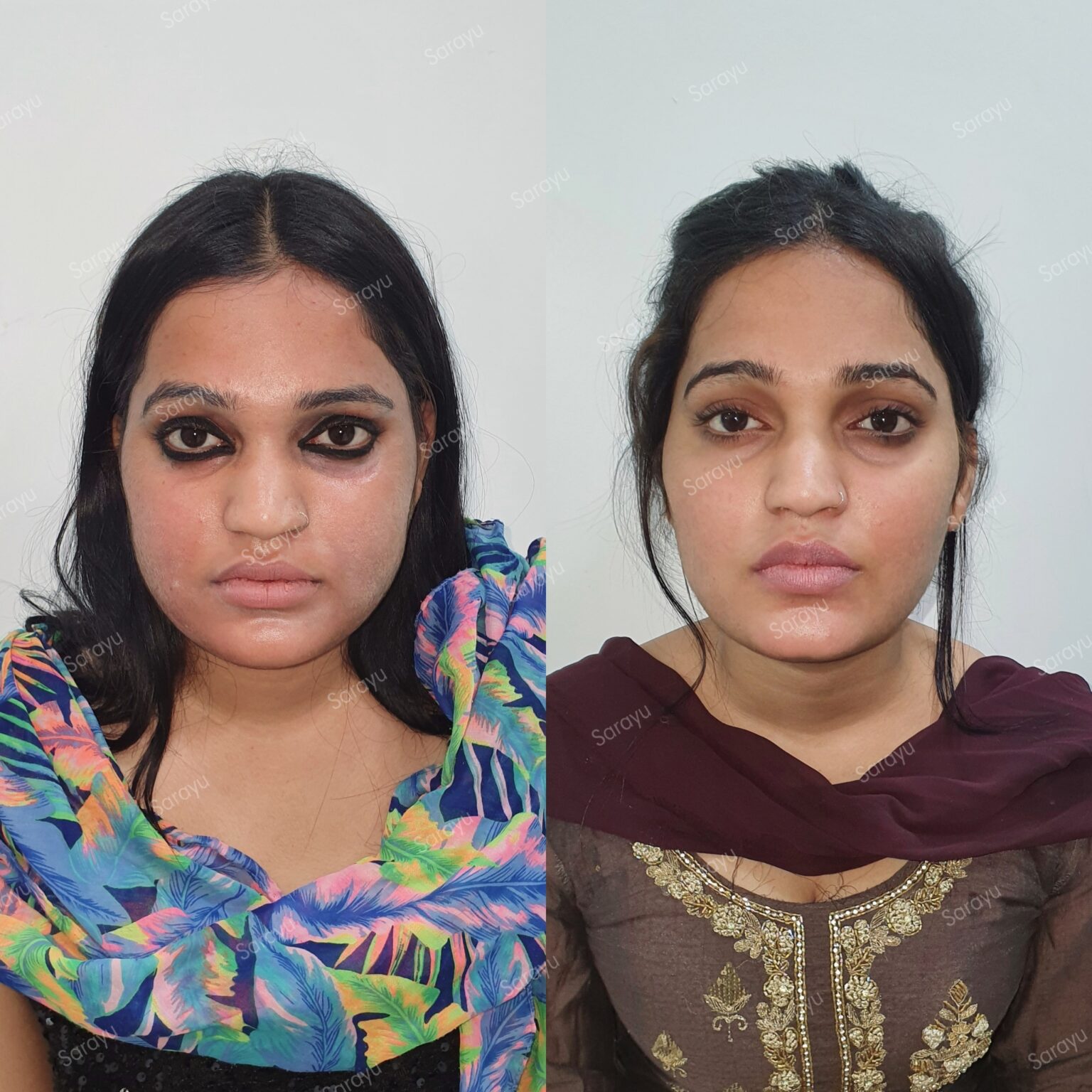 Face Fat Reduction Treatment in delhi 1536x1536 1 SARAYU CLINICS Buccal Fat Removal in Delhi