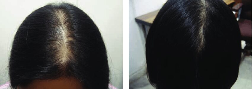 Professional female hair transplant in Delhi for fuller, natural hair.