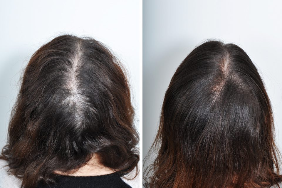 Hair Restoration 45 SARAYU CLINICS Female Hair Transplant in Delhi