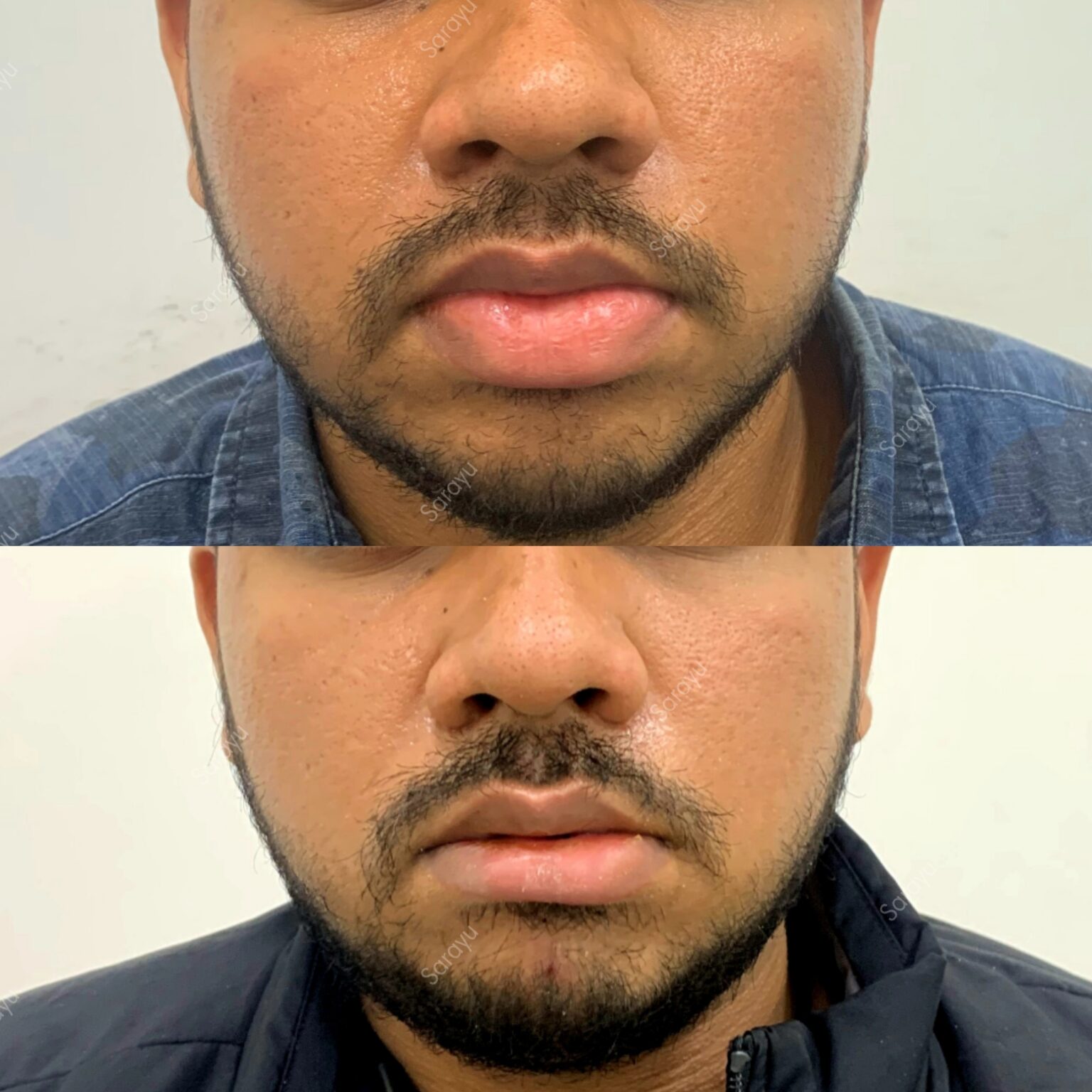 Lip Reduction for Men in Delhi 1536x1536 1 SARAYU CLINICS Lip Reduction Treatment in Delhi