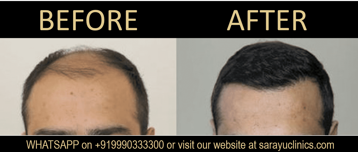 Microscopic FUE Hair Transplant in Delhi SARAYU CLINICS Microscopic FUE Hair Transplant in Delhi