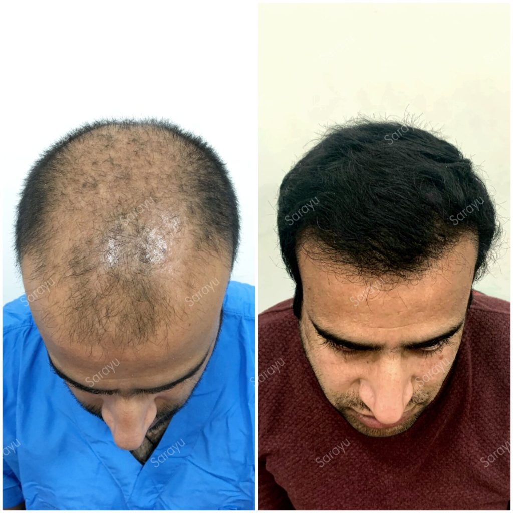 Photo 1623867222956 1536x1536 1 SARAYU CLINICS FUT vs FUE Hair Transplant