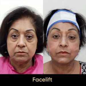 1 10 SARAYU CLINICS Korean Facelift in Delhi