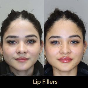 1 12 SARAYU CLINICS Lip Fillers Treatment in Delhi