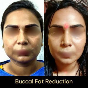 1 6 SARAYU CLINICS Buccal Fat Removal in Delhi