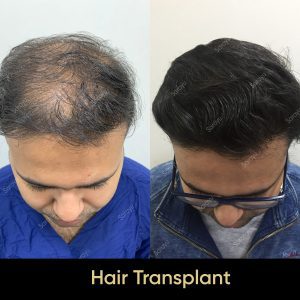 11 2 SARAYU CLINICS Hair Transplant in Delhi