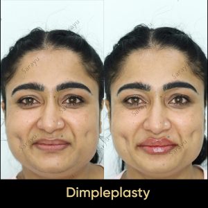 2 15 SARAYU CLINICS Dimpleplasty in Delhi