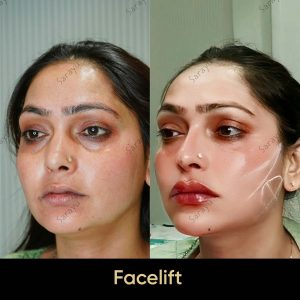 2 16 SARAYU CLINICS Korean Facelift in Delhi