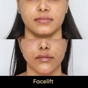 3 6 SARAYU CLINICS Korean Facelift in Delhi