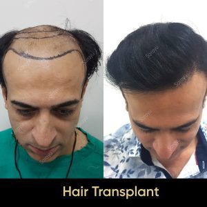 4 11 SARAYU CLINICS Hair Transplant in Delhi