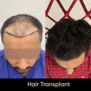 6 5 SARAYU CLINICS Hair Transplant in Delhi