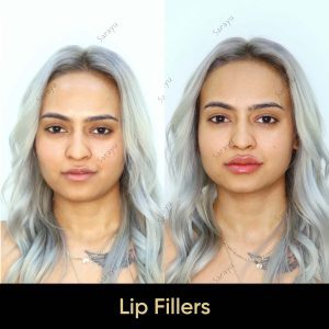 7 5 SARAYU CLINICS Lip Fillers Treatment in Delhi