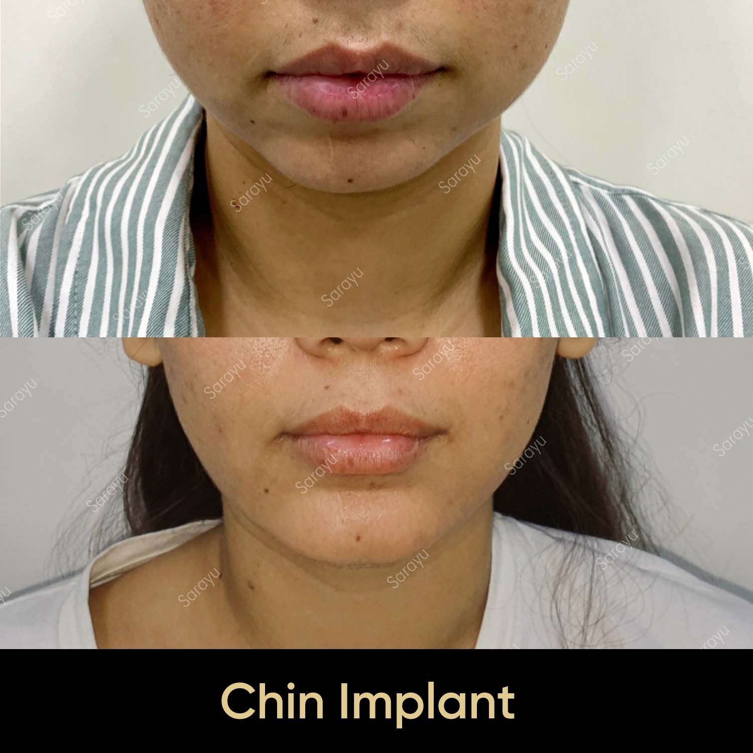 Close-up of a face with a balanced and defined jawline after chin implant surgery in Delhi