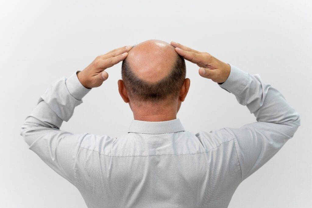 Close-up photo of a hair transplant procedure being performed by a skilled surgeon in Delhi.