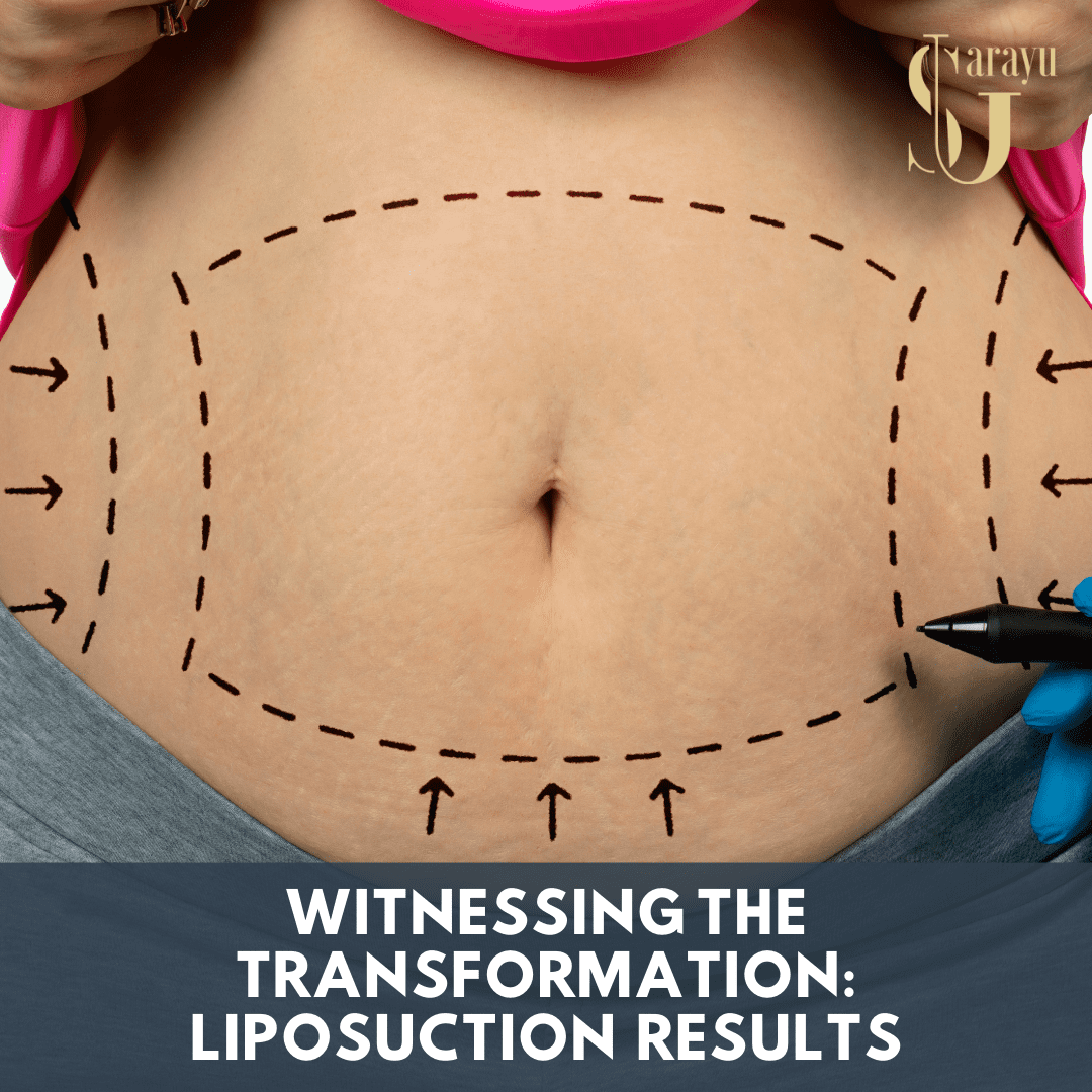 Dr. Adarsh Tripathi, a leading liposuction surgeon in Delhi, India.