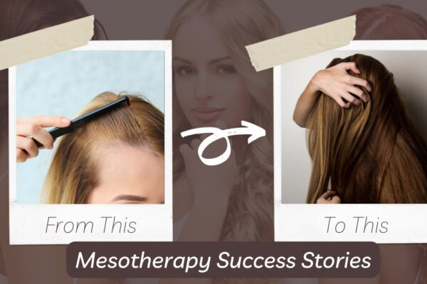 Mesotherapy treatment for hair loss in Delhi, India