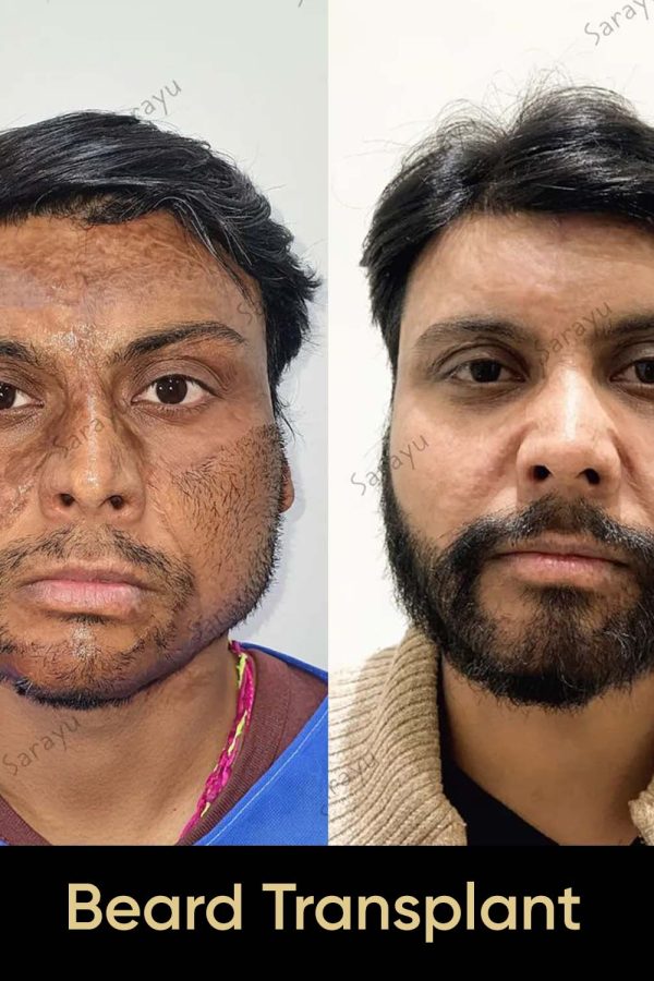 Close-up of a face with a full, natural-looking beard after Beard Hair Transplant Surgery