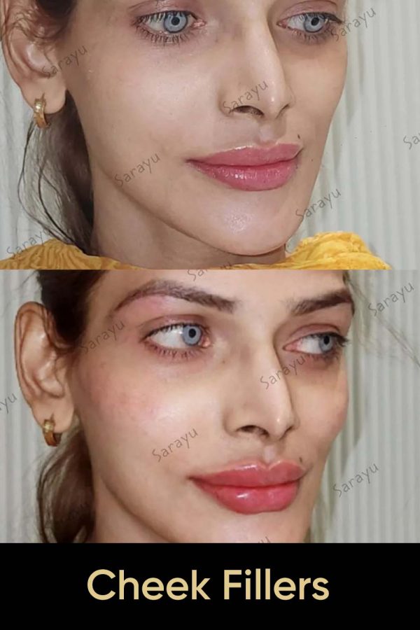 Close-up of a person's face with balanced, natural-looking facial contours after cheek filler procedure performed by Dr Adarsh tripathi in Delhi