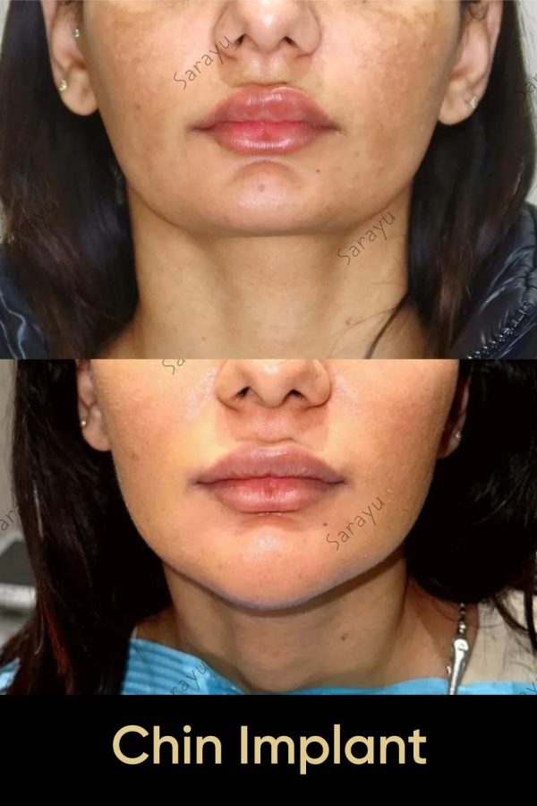 Close-up of a face with a balanced and defined jawline after chin implant surgery in Delhi