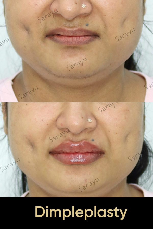 Close-up of a person's face with balanced and natural-looking features after Dimpleplasty procedure in Delhi