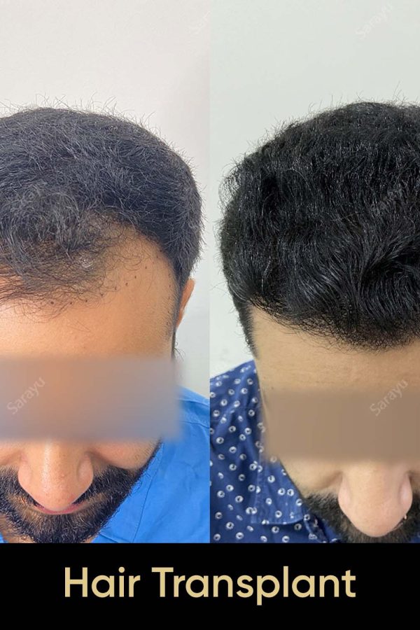 Close-up of healthy scalp with restored hair after a hair transplant procedure in Delhi.