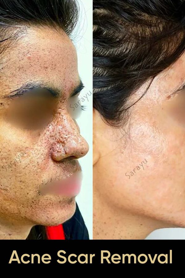 Close-up of a person with improved skin texture and reduced acne scars after Acne Scar Removal Treatment in Delhi