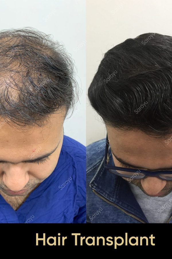 Close-up of healthy scalp with restored hair after a hair transplant procedure in Delhi.