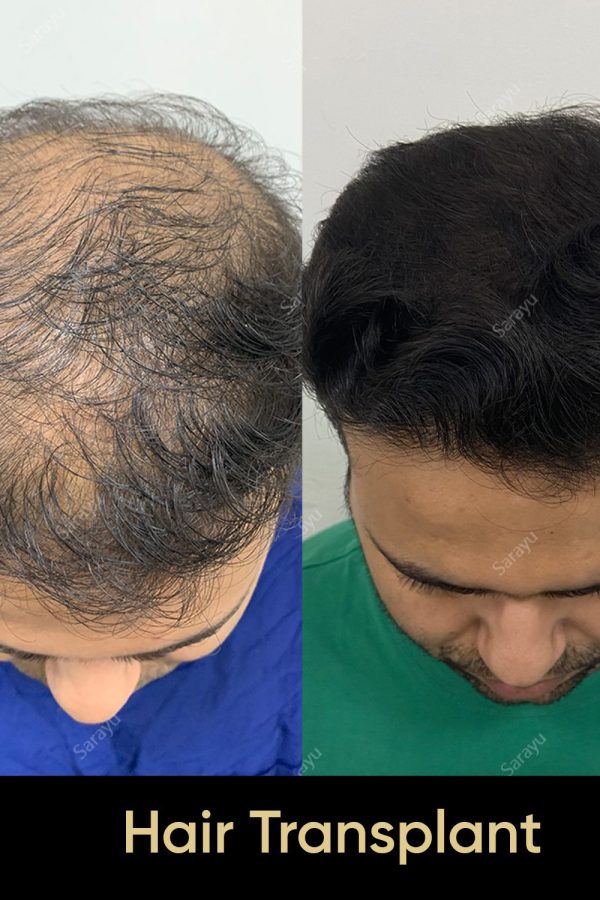 Close-up of healthy scalp with restored hair after a hair transplant procedure in Delhi.