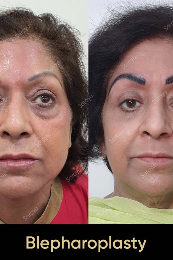 Close-up of a person with refreshed eyes exhibiting smoother skin and reduced signs of aging around the eyelids after Blepharoplasty Surgery in Delhi