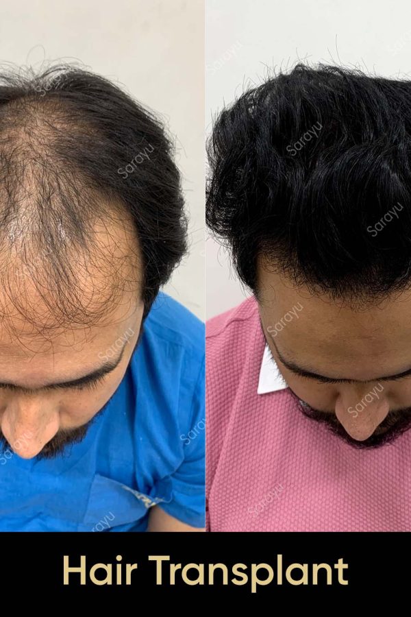 Close-up of healthy scalp with restored hair after a hair transplant procedure in Delhi.