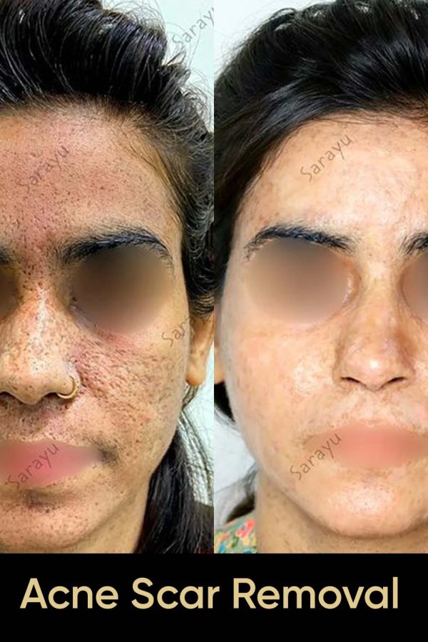 Close-up of a person with improved skin texture and reduced acne scars after Acne Scar Removal Treatment in Delhi