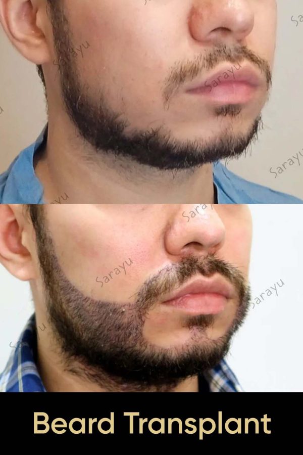 Close-up of a face with a full, natural-looking beard after Beard Hair Transplant Surgery