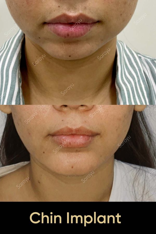 Close-up of a face with a balanced and defined jawline after chin implant surgery in Delhi