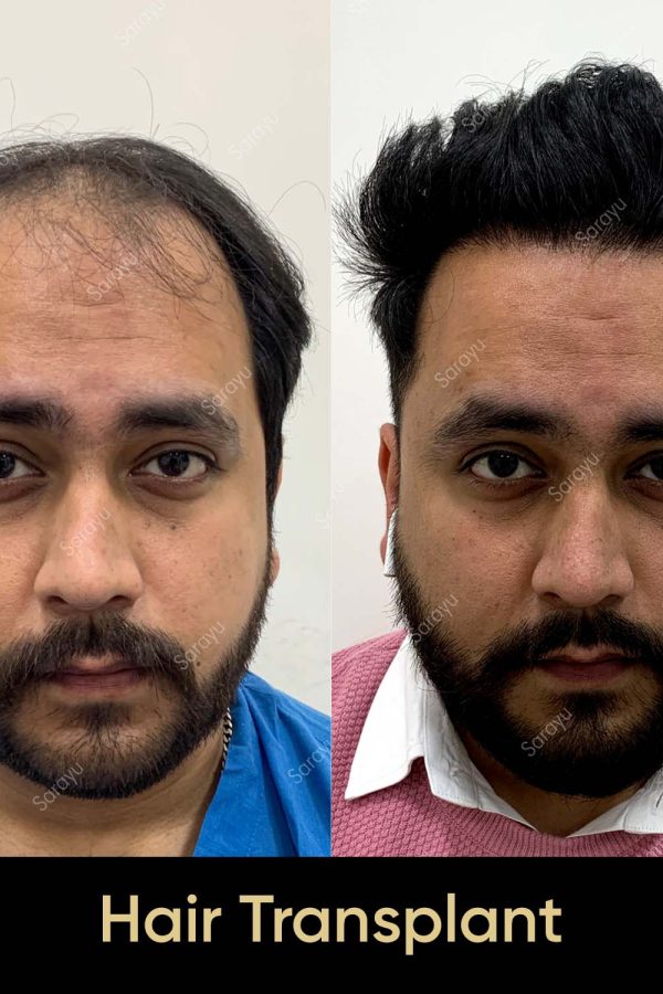 Close-up of healthy scalp with restored hair after a hair transplant procedure in Delhi.