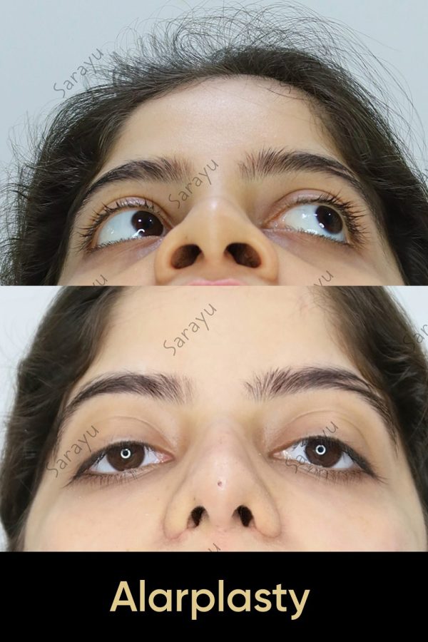 Close-up of a face with a slightly refined nose profile after Alarplasty Surgery in Delhi