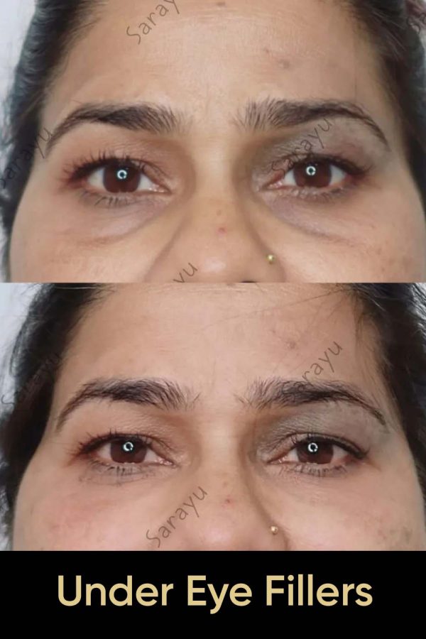 Close-up of a person's face with improved under-eye area smoothness and reduced appearance of dark circles/puffiness.