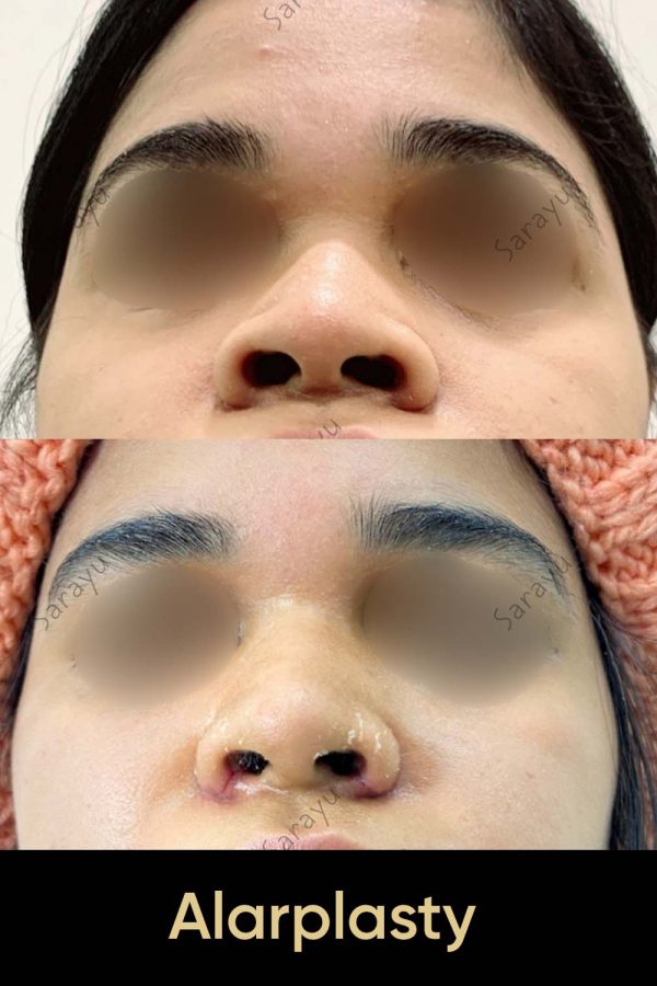 Close-up of a face with a slightly refined nose profile after Alarplasty Surgery in Delhi