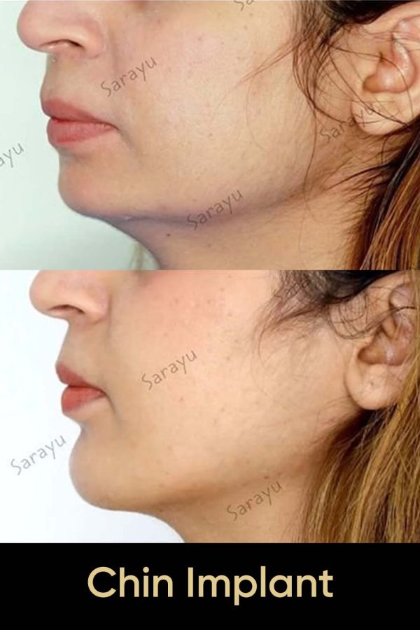 Close-up of a face with a balanced and defined jawline after chin implant surgery in Delhi