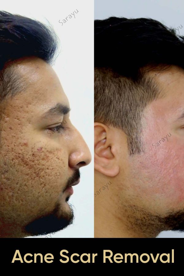 Close-up of a person with improved skin texture and reduced acne scars after Acne Scar Removal Treatment in Delhi