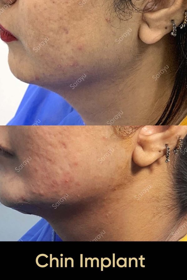 Close-up of a face with a balanced and defined jawline after chin implant surgery in Delhi