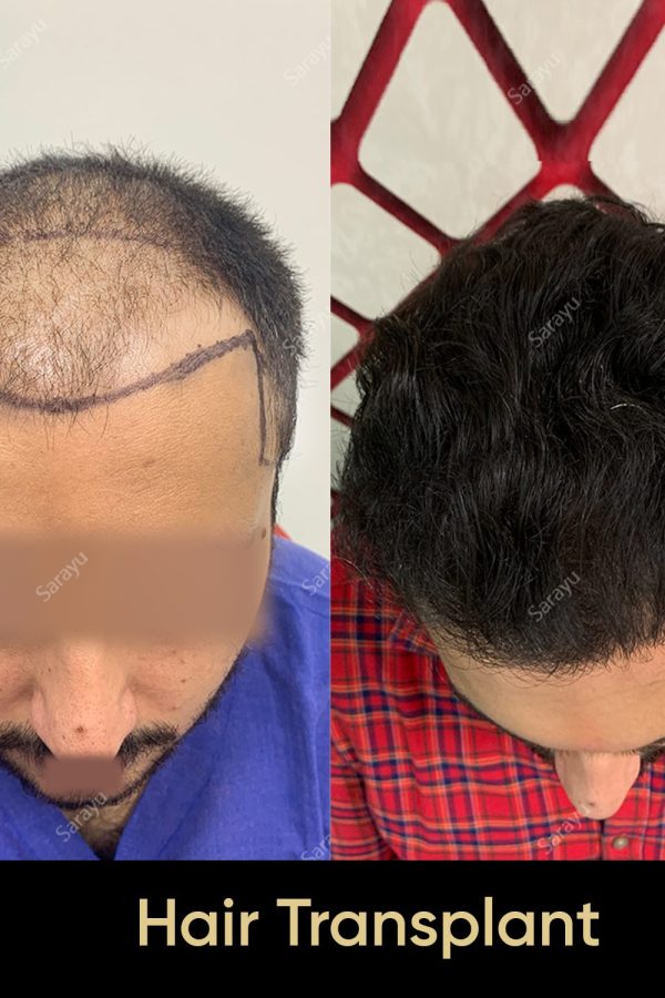 Close-up of healthy scalp with restored hair after a hair transplant procedure in Delhi.