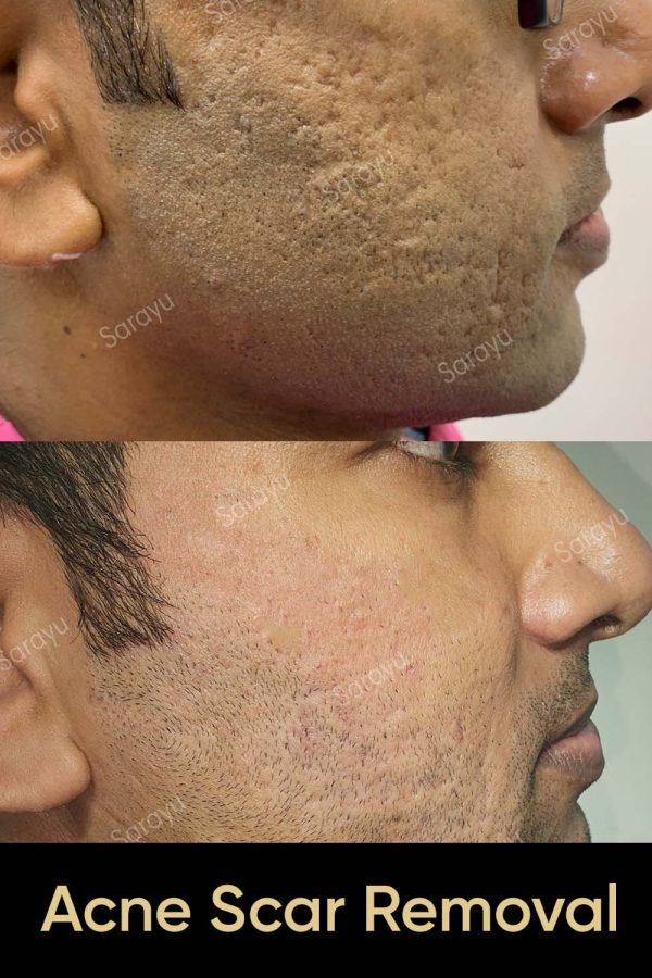 Close-up of a person with improved skin texture and reduced acne scars after Acne Scar Removal Treatment in Delhi