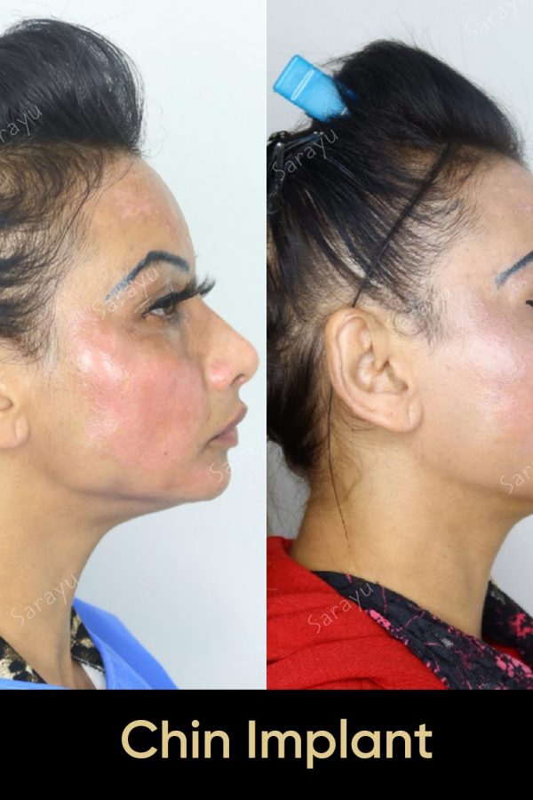 Close-up of a face with a balanced and defined jawline after chin implant surgery in Delhi