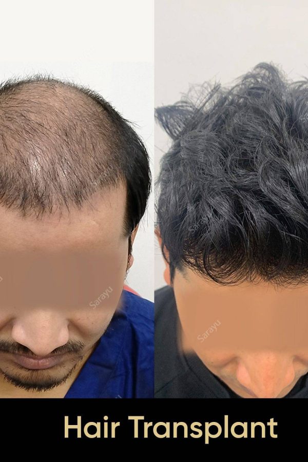 Close-up of healthy scalp with restored hair after a hair transplant procedure in Delhi.