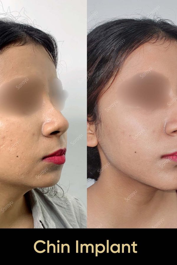 Close-up of a face with a balanced and defined jawline after chin implant surgery in Delhi